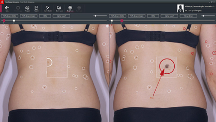 Σπίλοι (Ελιές): Νέα Ψηφιακή μέθοδος για την Ολόσωμη Χαρτογράφηση & την Πρόληψη του Δερματικού Καρκίνου-3