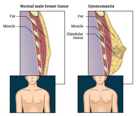 Αρρενωπότητα στο στόχαστρο της γυναικομαστίας-1