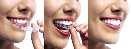 Αόρατη ορθοδοντική: Ισιώστε τα δόντια σας εύκολα και γρήγορα-1