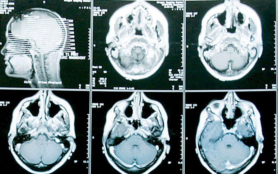 Στη μάχη κατά του καρκίνου μπορεί να βοηθήσει ο ιός Ζίκα-2