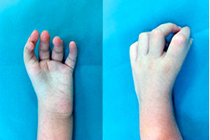 Συγγενής Απλασία του Αντίχειρα-1