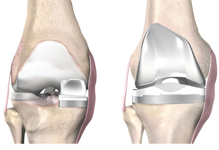 Ρομποτική χειρουργική γόνατος και ισχίου αποκλειστικά στο Metropolitan-2