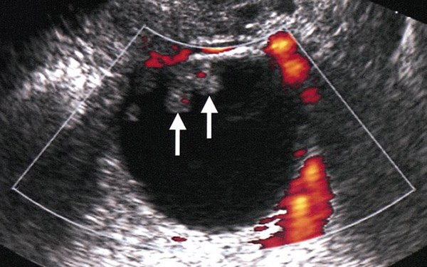 Το όνειρο έγινε πραγματικότητα: Εμεινε έγκυος με μία πρωτοποριακή μέθοδο αφαίρεσης όγκου ωοθηκών-2