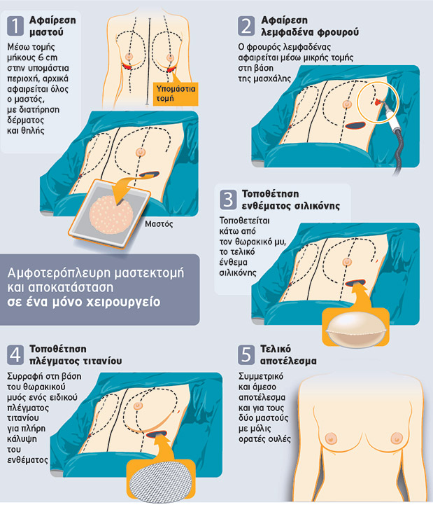 Aποκατάσταση μαστού σε ένα και μόνο χειρουργείο, στο Metropolitan-1