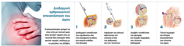 Τέλος στον πόνο λόγω ρήξης τενόντων του ώμου, στο Metropolitan-1