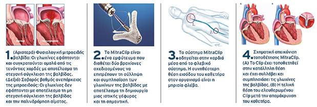 MitraClip στο Metropolitan: Επιδιόρθωση βαλβίδας της καρδιάς χωρίς διάνοιξη του θώρακα-1