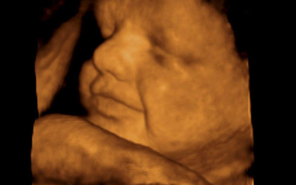 ο-αυτισμός-ίσως-αρχίζει-κατά-την-ενδομ-2014215