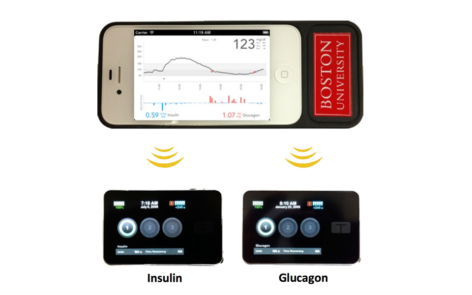 φορητό-τεχνητό-πάγκρεας-2029577