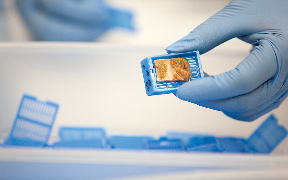 αιματολογικό-τεστ-για-τη-διάγνωση-αλτ-2034046