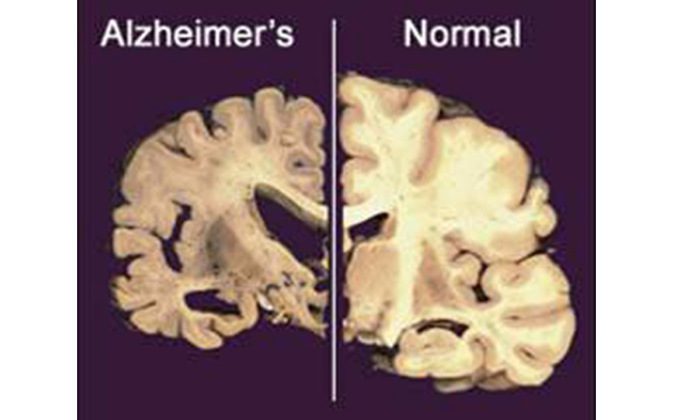 το-αλτσχάιμερ-μπορεί-να-προληφθεί-2035083