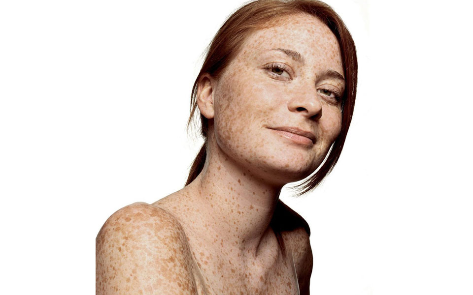 ενδειξη-καρκίνου-οι-κρεατοελιές-στον-2106847