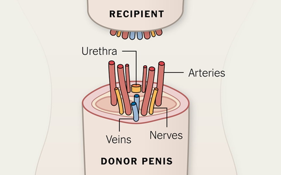 μεταμόσχευση-πέους-σε-αμερικανό-στρα-2113490