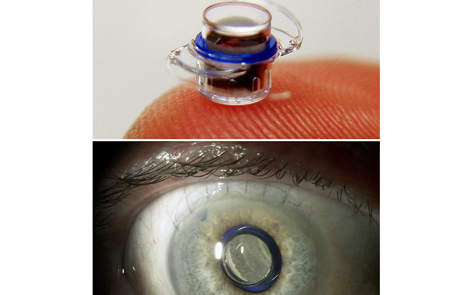 βιονική-όραση-για-ασθενείς-με-τύφλω-2167139