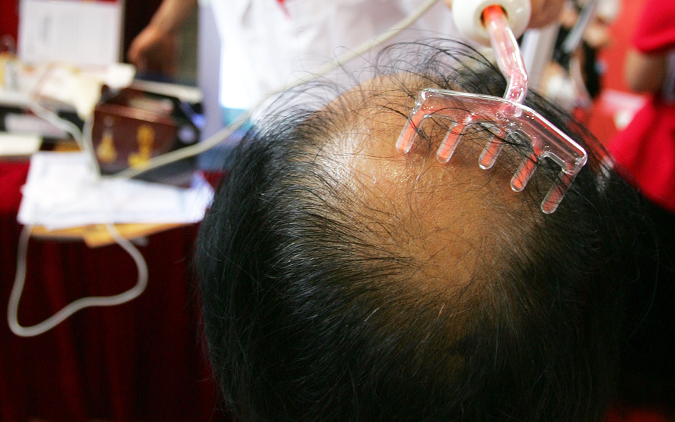 πιο-κοντά-στην-πρόβλεψη-της-φαλάκρας-2175616