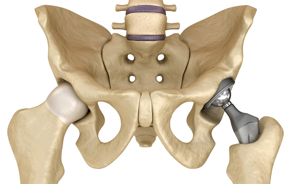 αναθεώρηση-της-ολικής-αρθροπλαστική-2203280
