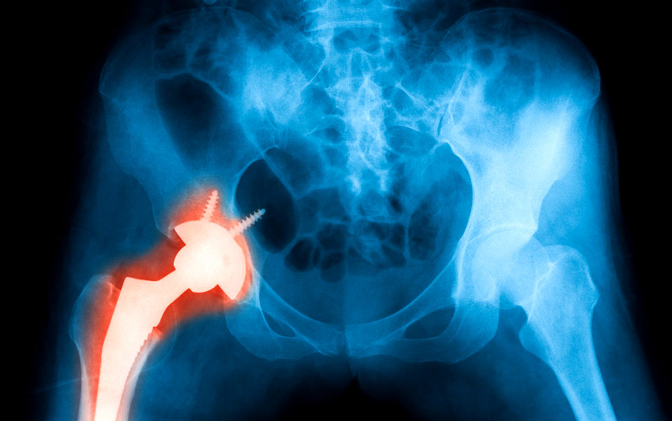 νέα-αρθροπλαστική-ισχίου-με-κοχλιωτά-2203257
