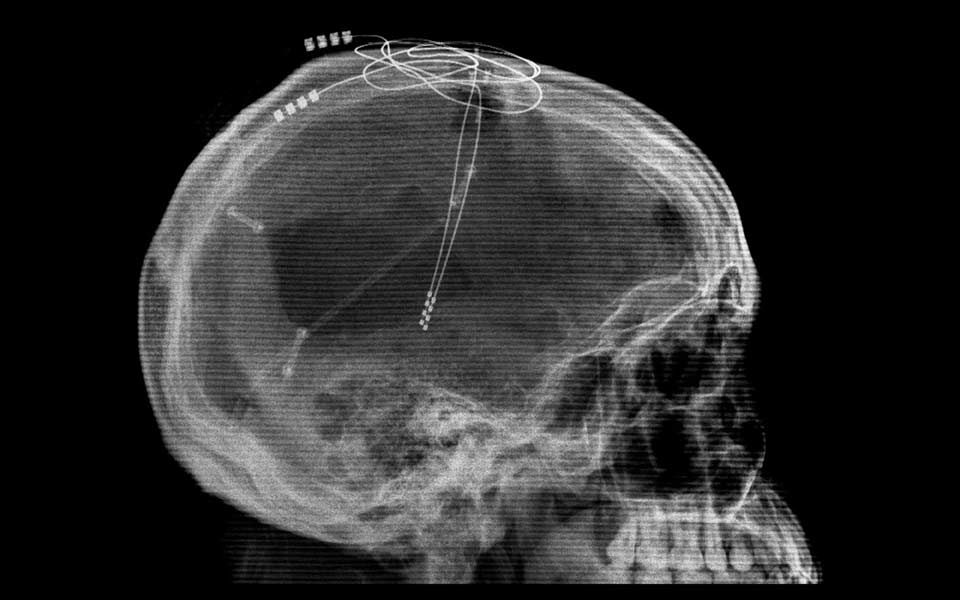η-έντονη-άσκηση-σταματάει-την-εξέλιξη-2222966