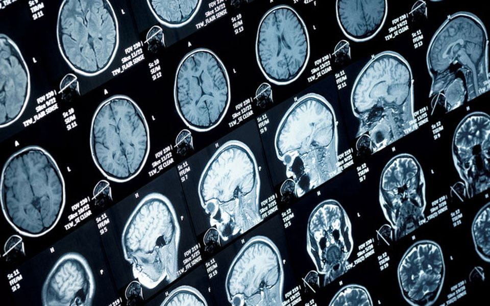 νέες-ελπίδες-για-την-πολλαπλή-σκλήρυν-2239705