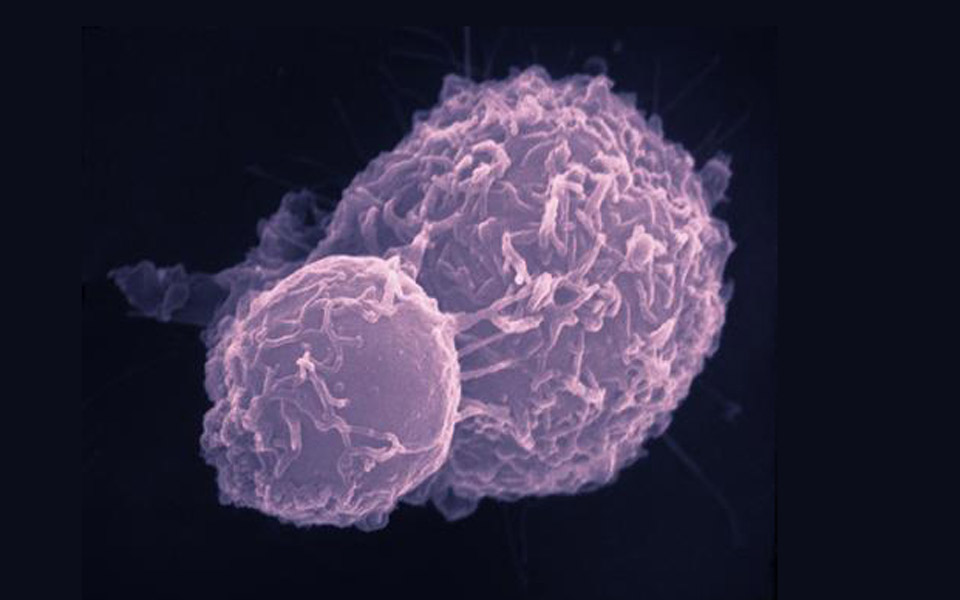 σε-άνοδο-η-εμφάνιση-καρκίνου-του-παχέο-2253541