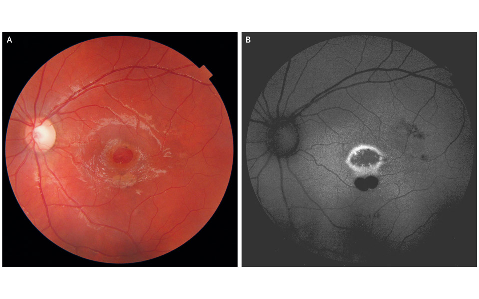 εννιάχρονος-έχασε-το-80-της-όρασής-του-α-2257693