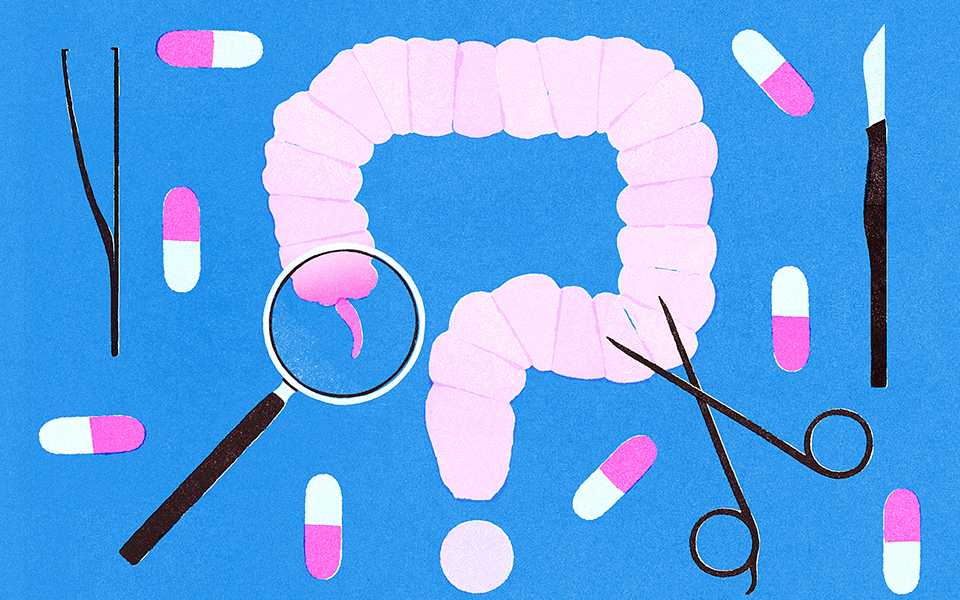 αντιμετώπιση-σκωληκοειδίτιδος-με-αν-2284831