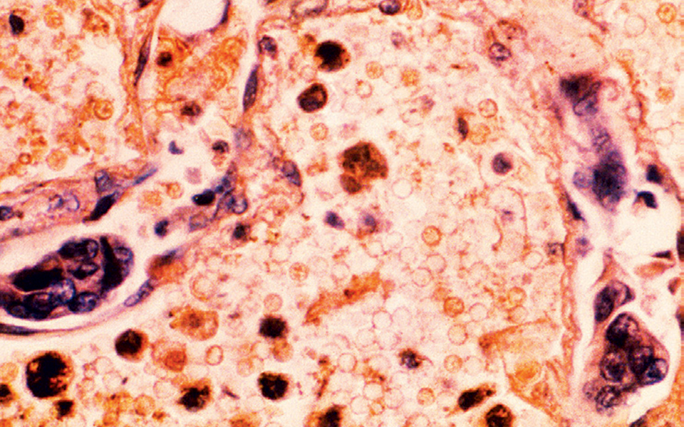 ελπίδες-για-θεραπεία-κάθε-μορφής-καρκ-2359378