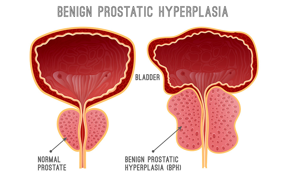 καλοήθης-υπερπλασία-του-προστάτη-κυπ-561307831