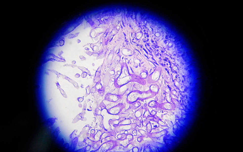 ινδία-ο-μαύρος-μύκητας-που-επιτίθετ-561357427