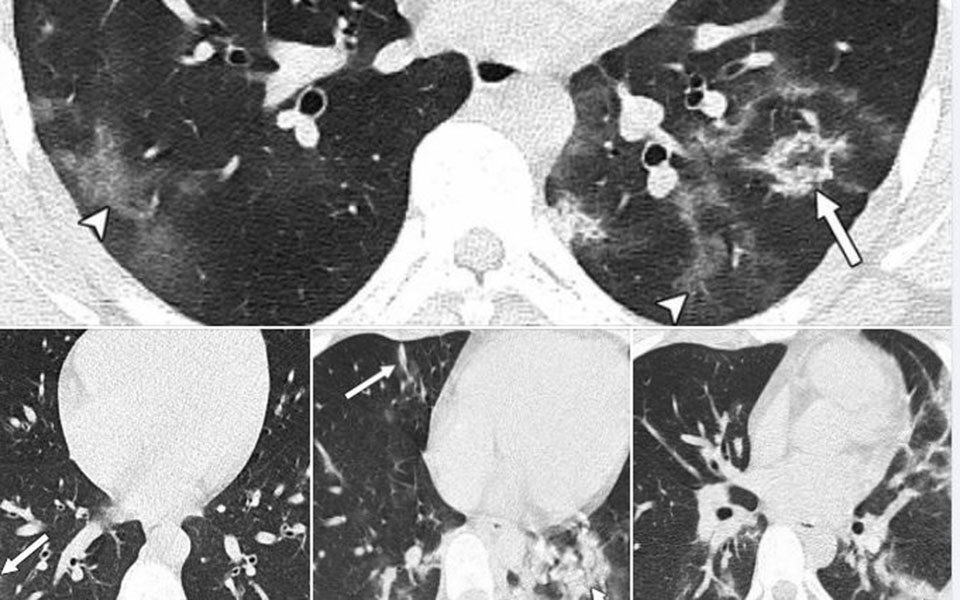 μαγιορκίνης-οι-βλάβες-που-προκαλεί-ο-covid-561470782