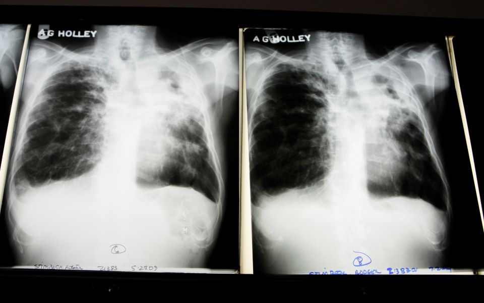 nέα-ευρήματα-για-τη-φυματίωση-μεταδίδε-561548569