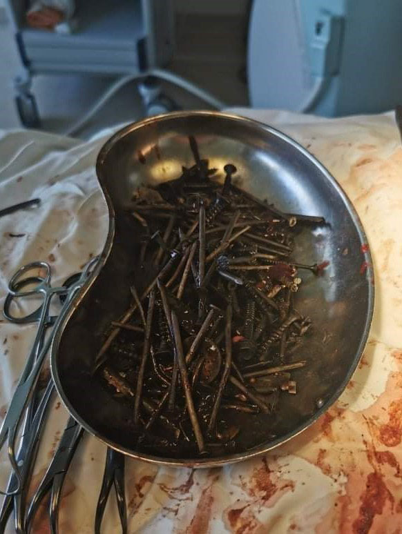 Λιθουανία: Βίδες και καρφιά βρέθηκαν στο στομάχι ασθενούς-1