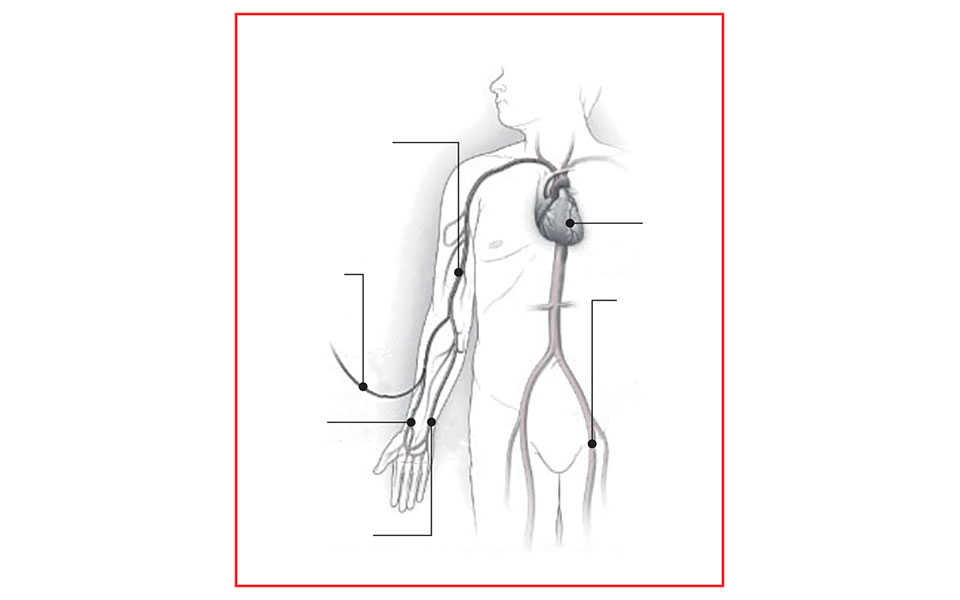 Αγγειοπλαστική και στεντ από τον βραχίονα-1
