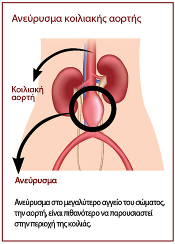 Σε ποιους, πότε και γιατί κάνουμε έλεγχο για ανεύρυσμα κοιλιακής αορτής;-1