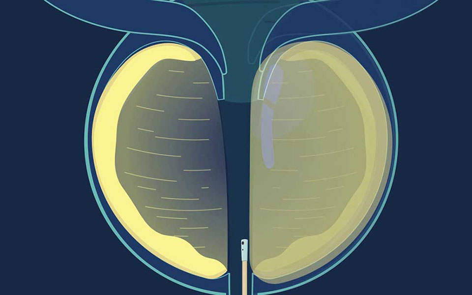 REZUM-HoLEP: Το μέλλον για την καλοήθη υπερπλασία του προστάτη-1