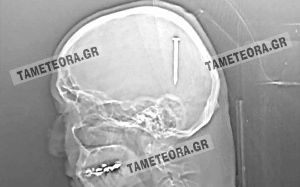 καλαμπάκα-του-σφηνώθηκε-καρφί-μέσα-στ-561818992