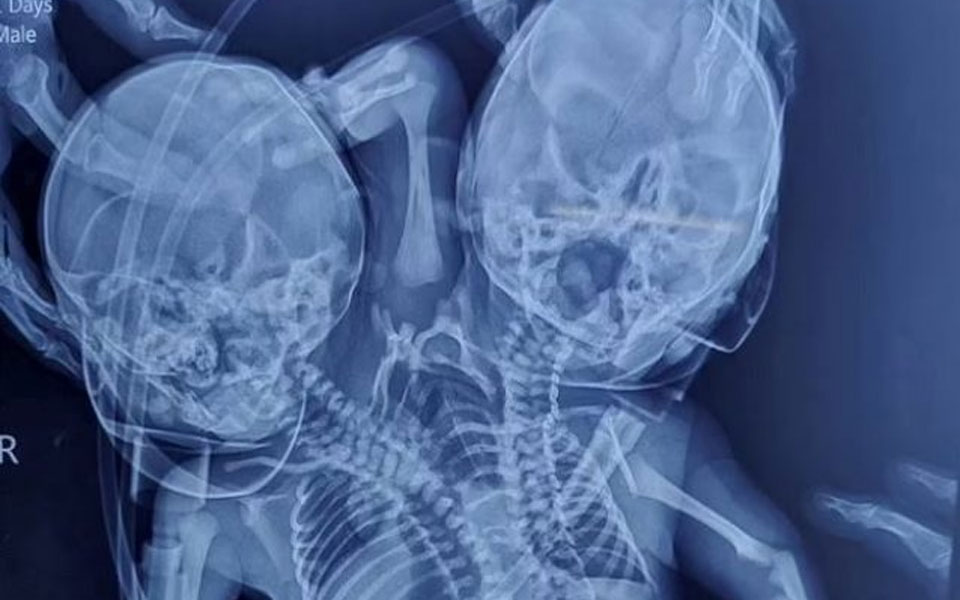 ινδία-γεννήθηκε-μωρό-με-δύο-κεφάλια-τρ-561789043