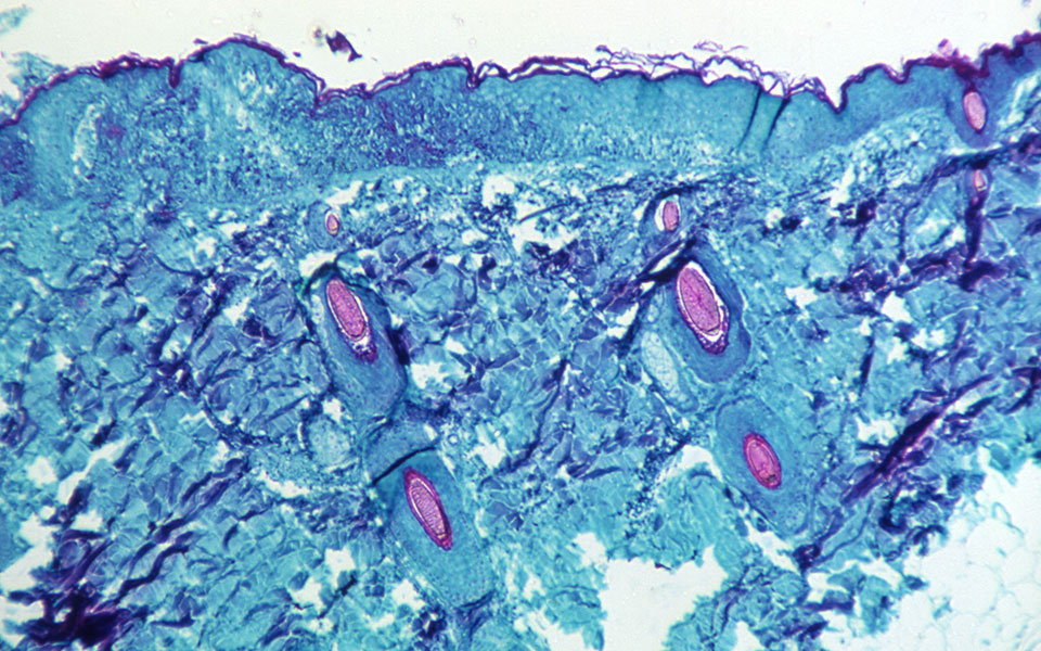ευλογιά-των-πιθήκων-αύριο-τα-αποτελέσ-561872686