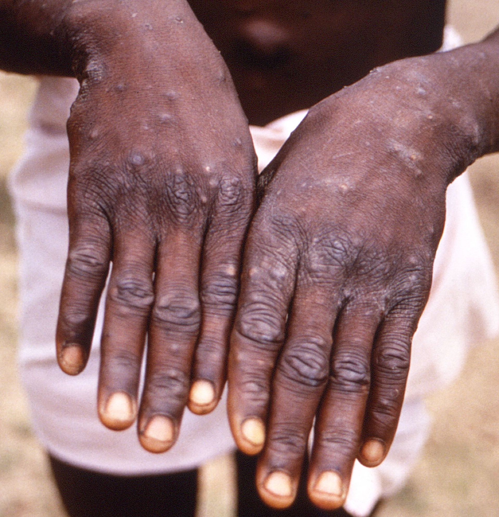 συναγερμός-για-την-ευλογιά-των-πιθήκω-561868423