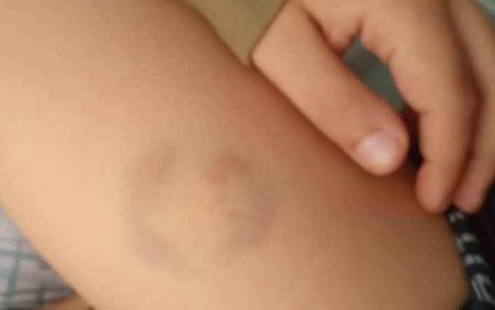 Άρτα: Μητέρα καταγγέλλει ότι διευθύντρια σχολείου δάγκωσε τον 11χρονο γιο της-1