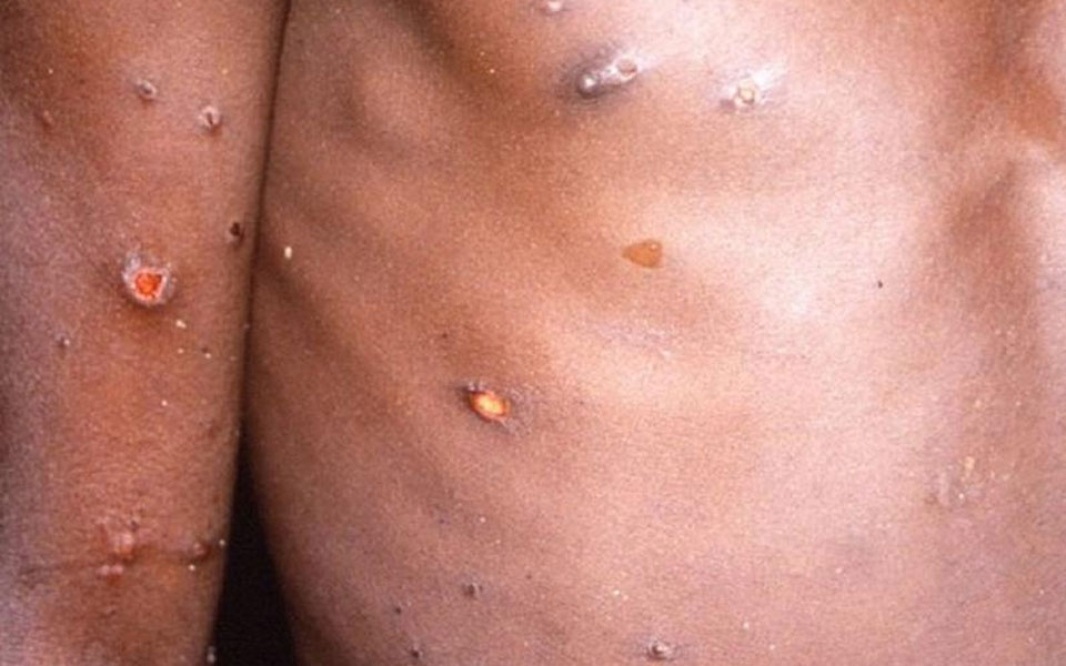 μαγιορκίνης-για-ευλογιά-των-πιθήκων-ε-561872542