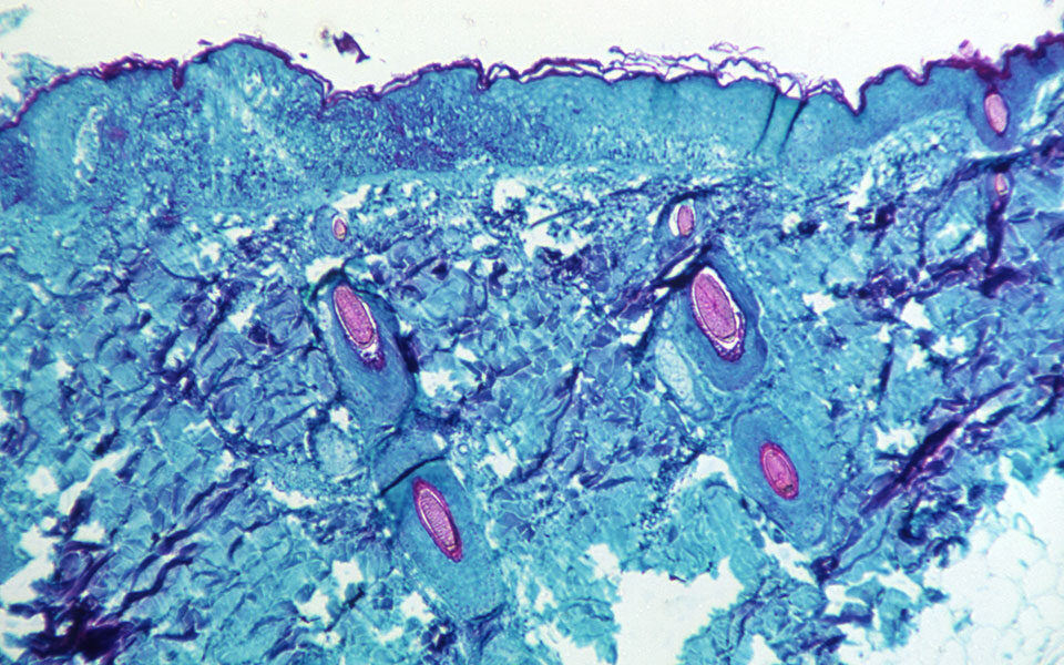 μόσιαλος-για-ευλογιά-των-πιθήκων-να-μη-561874906