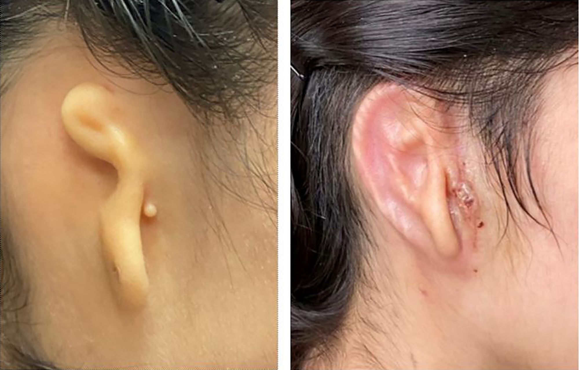 τρισδιάστατο-εκτυπωμένο-αυτί-μεταμο-561891100