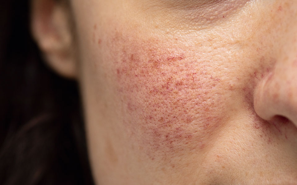 η-ροδόχρους-ακμή-μπορεί-να-εμφανίσει-έ-561907762