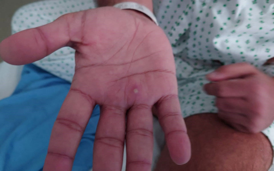 Εxplainer: Πόσο πρέπει να μας ανησυχεί η ευλογιά των πιθήκων;-1