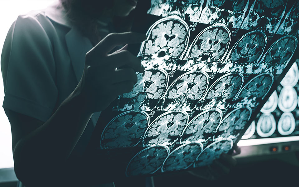 αλτσχάιμερ-πειραματικό-φάρμακο-επιβ-562162282