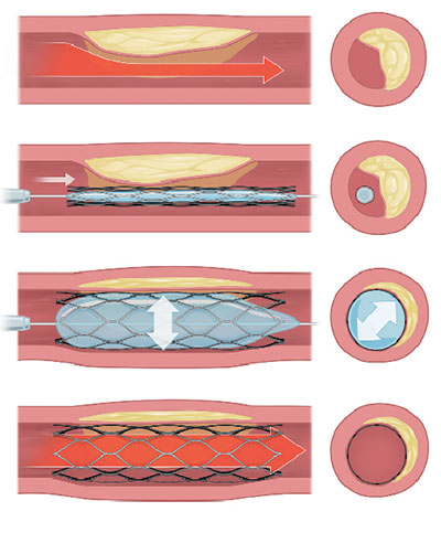 Τι πρέπει να ξέρετε για τα stents-1