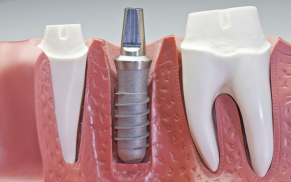 Σημαντικές εξελίξεις στα οδοντικά εμφυτεύματα-1