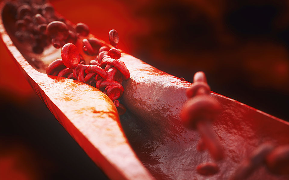 kαταπολεμήστε-τη-χρόνια-φλεγμονή-και-τ-562203211