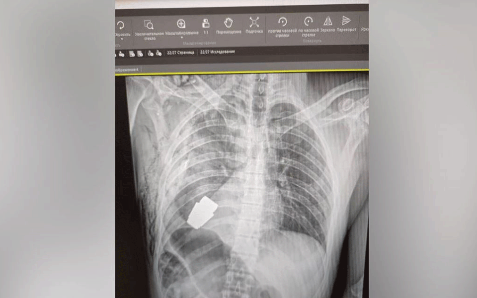 ουκρανία-γιατροί-αφαίρεσαν-χειροβομ-562227145