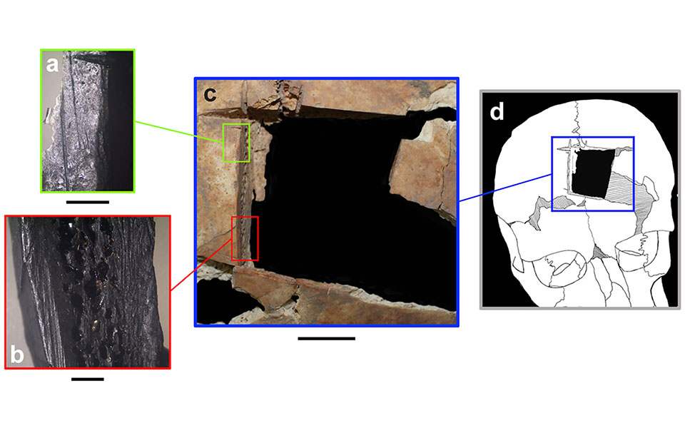 ενδειξη-για-χειρουργική-εγκεφάλου-πρ-562293250